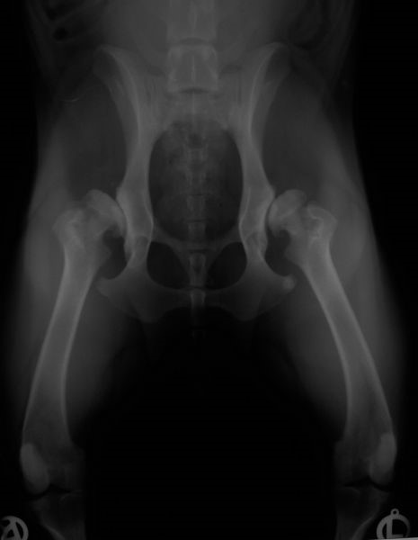 dysplazja skrajna dysplazja biodrowa